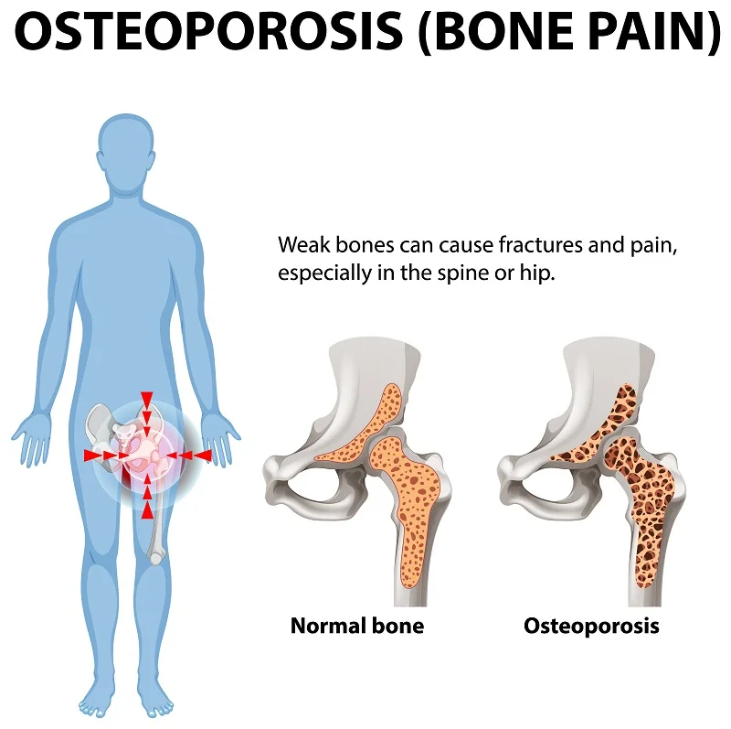 Illustration of hip bone pain and bone density loss showing need for Osteoporosis Bone Pain Treatment in Gurgaon by Dr. (Prof.) Ravi Sauhta