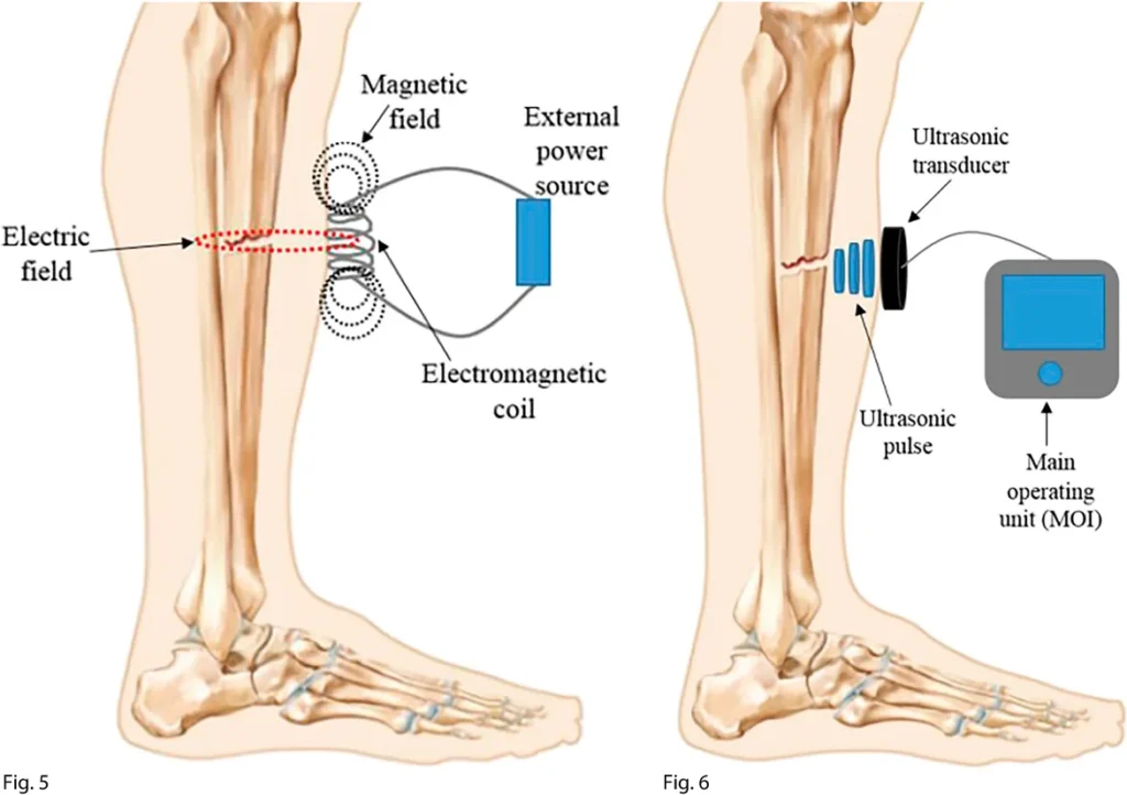 Illustration of bone healing stimulation using electromagnetic and ultrasonic therapy for Non Healing Fracture Treatment in Gurgaon by Dr. (Prof.) Ravi Sauhta