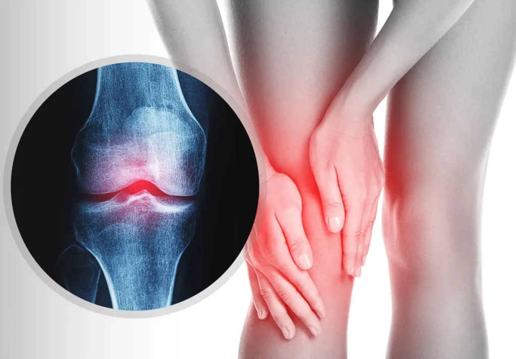 Knee pain with X-ray highlighting bone abnormality for Musculoskeletal Tumor Treatment in Gurgaon by Dr. (Prof.) Ravi Sauhta