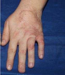 Close-up image of injured hand with deformity treated by Hand Fracture Specialist in Gurgaon Dr. (Prof.) Ravi Sauhta
