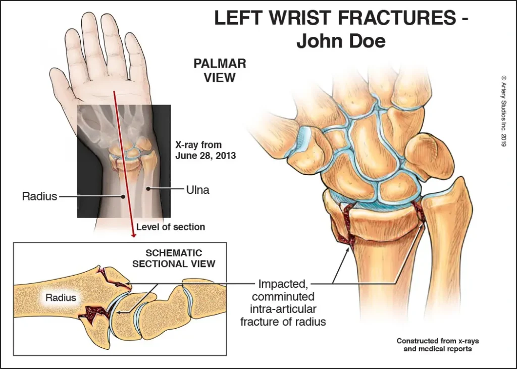 Illustration of wrist fracture with radius and ulna damage showing Juxta-Articular Fracture Fixation in Gurgaon by Dr. (Prof.) Ravi Sauhta