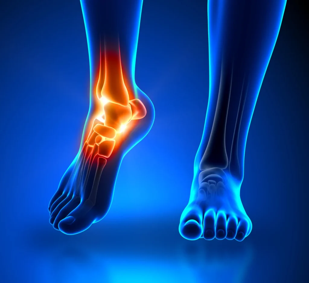 Ankle joint inflammation highlighted in foot X-ray illustrating precise diagnosis for foot & ankle disorders in Gurgaon by Dr. (Prof.) Ravi Sauhta
