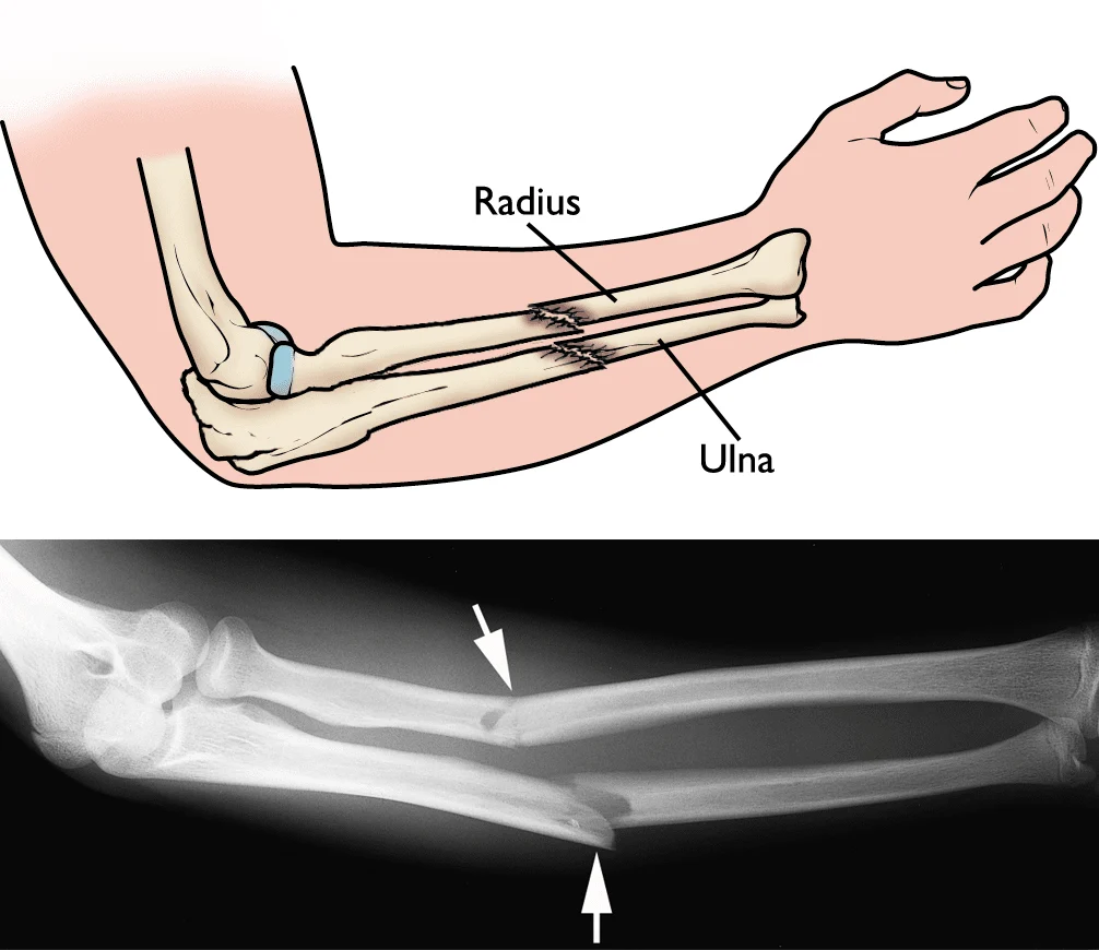 Illustration and X-ray of forearm fracture involving radius and ulna showing Intra-Articular Fracture Surgery in Gurgaon and complex joint reconstruction by Dr. (Prof.) Ravi Sauhta