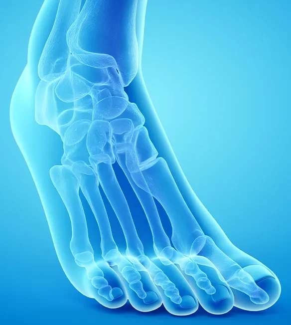 3D X-ray view of foot bones showing fracture and healing process highlighting NON-UNION & BONE HEALING – Advanced Fracture Reconstruction in Gurgaon by Dr. (Prof.) Ravi Sauhta
