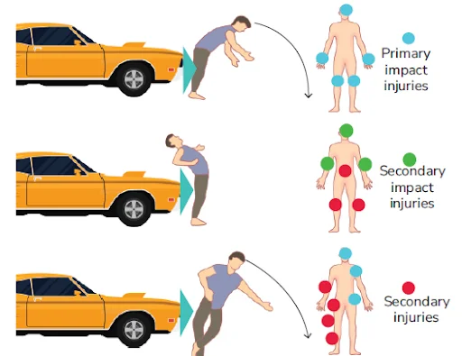 Illustration showing car accident impact injuries representing High Velocity Trauma Treatment in Gurgaon by Dr. (Prof.) Ravi Sauhta