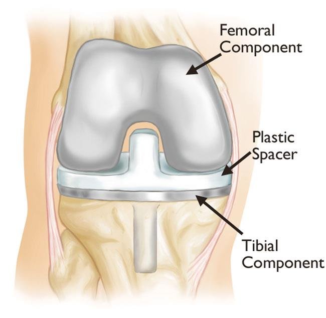 Diagram of knee replacement components including femoral, tibial, and spacer parts used in Revision Orthopedic Surgery in Gurgaon by Dr. (Prof.) Ravi Sauhta
