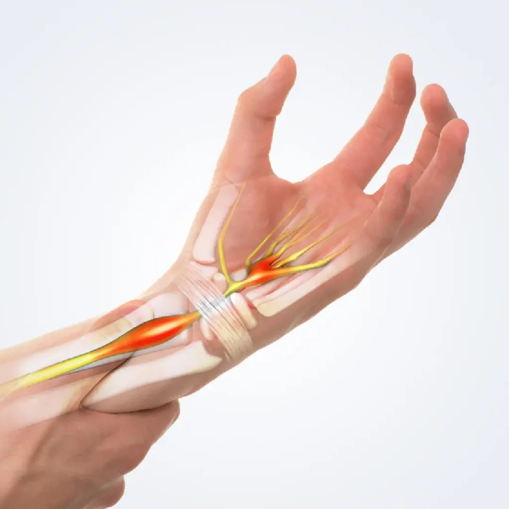 Hand and wrist nerve compression illustration showing personalized treatment planning in Gurgaon by Dr. (Prof.) Ravi Sauhta