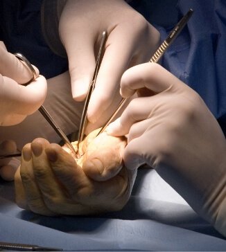 Surgeon performing delicate hand operation showcasing Hand Reconstruction Surgery in Gurgaon by Dr. (Prof.) Ravi Sauhta