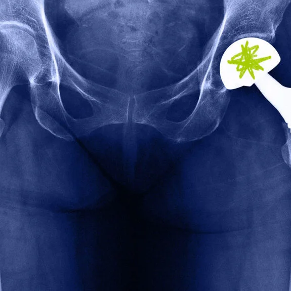 Hip X-ray showing joint damage for Hip Replacement in Gurgaon by Dr. (Prof.) Ravi Sauhta